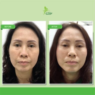 Căng Da Mặt Chỉ Collagen Lifting 4D