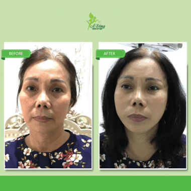 Căng Da Mặt Chỉ Collagen Lifting 4D