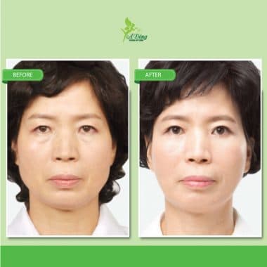 Căng Da Mặt Chỉ Collagen Lifting 4D