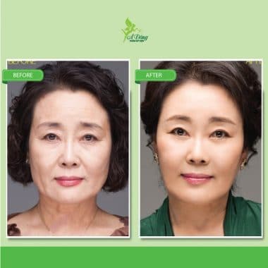 Căng Da Mặt Chỉ Collagen Lifting 4D