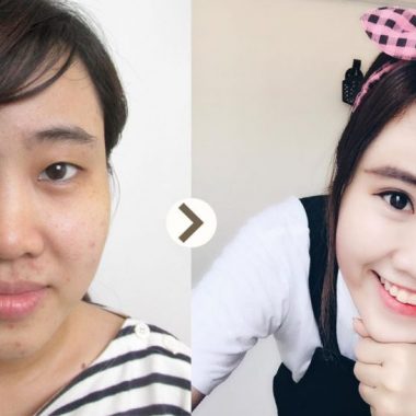 Bấm mí mắt Nano Hàn Quốc