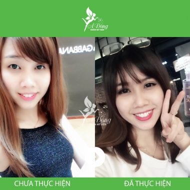 Bấm mí mắt Nano Hàn Quốc