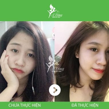 Bấm mí mắt Nano Hàn Quốc