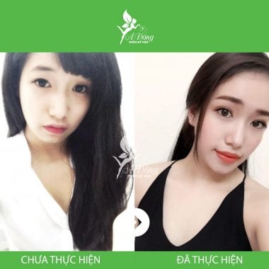 Bấm mí mắt Nano Hàn Quốc