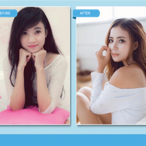 Nâng Mũi Sline Cấu Trúc