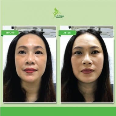 Căng Da Mặt Chỉ Collagen Lifting 4D