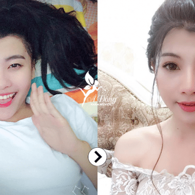 Bấm mí mắt Nano Hàn Quốc