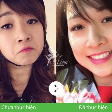 Bấm mí mắt Nano Hàn Quốc