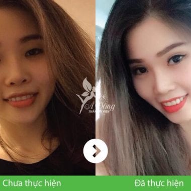 Bấm mí mắt Nano Hàn Quốc