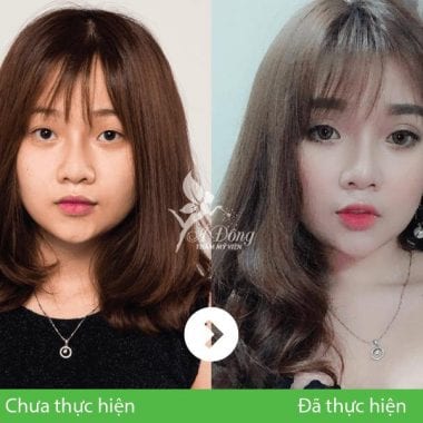 Bấm mí mắt Nano Hàn Quốc