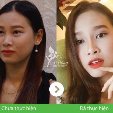 Nâng Mũi Sline Cấu Trúc