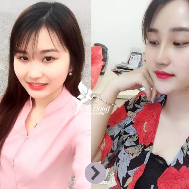 Nâng Mũi Sline Cấu Trúc