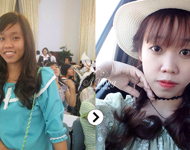 Trắng da mặt Stem Cell White Skin