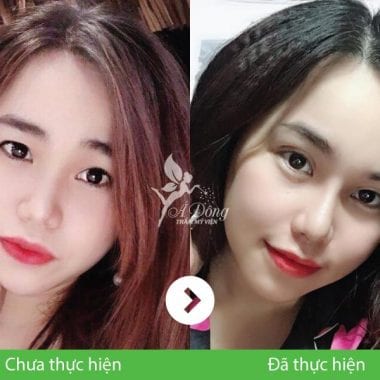 Nâng Mũi Sline Cấu Trúc