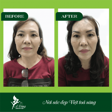 Nâng chân mày bằng chỉ Eye Beauty Cog