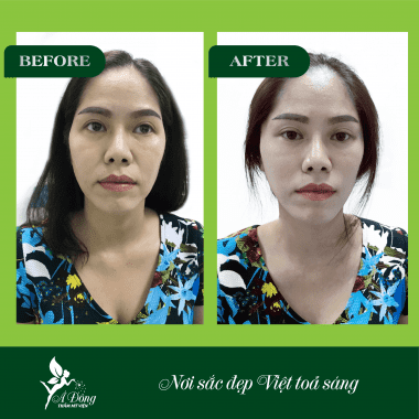 Căng Da Mặt Chỉ Collagen Lifting 4D