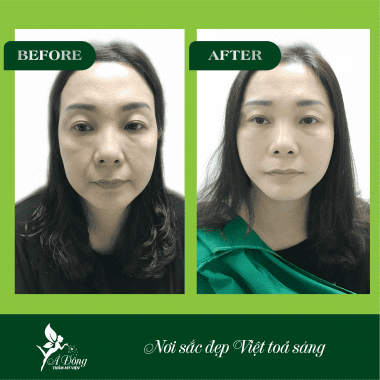 Căng Da Mặt Chỉ Collagen Lifting 4D