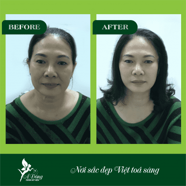 Căng Da Mặt Chỉ Collagen Lifting 4D