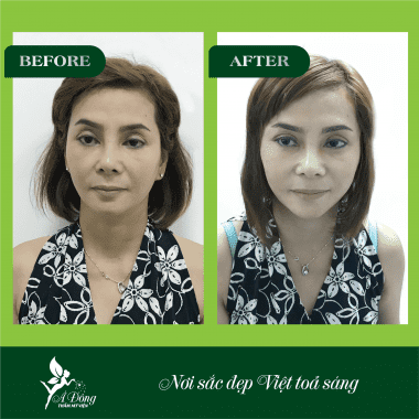 Căng Da Mặt Chỉ Collagen Lifting 4D