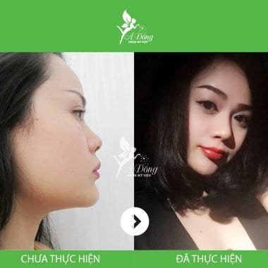 Nâng Mũi Sline Cấu Trúc