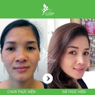 Nâng Mũi Sline Cấu Trúc