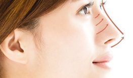 THU GỌN CÁNH MŨI KHÔNG PHẪU THUẬT