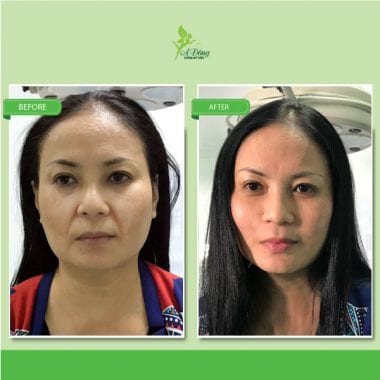 Căng Da Mặt Chỉ Collagen Lifting 4D