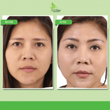 Nâng chân mày bằng chỉ Eye Beauty Cog