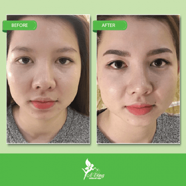 Nâng chân mày bằng chỉ Eye Beauty Cog