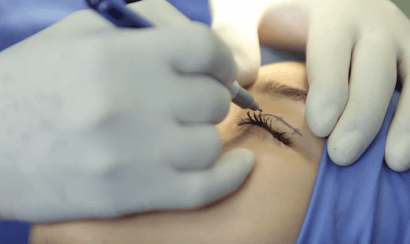 Xác định, đánh dấu vùng mắt bị sụp cơ