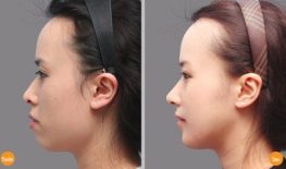 LÀM ĐẦY VÙNG TRÁN