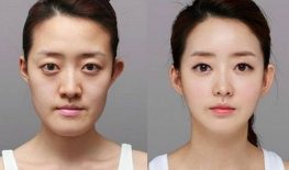 LÀM ĐẦY RÃNH MŨI MÁ BẰNG CHỈ COLLAGEN 3D