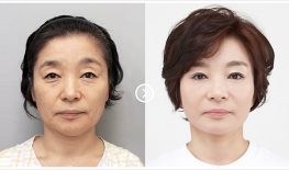 TRẺ HÓA DA PERFECT HIFU GOLD