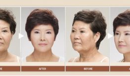 XÓA NHĂN RÃNH MŨI MÁ