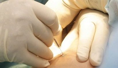 Sát trùng và gây tê núm vú