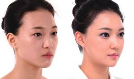 CẤY MỠ TỰ THÂN VÙNG TRÁN