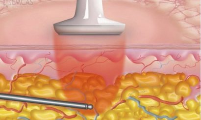 Tiến hành quy trình hút mỡ nọng cằm