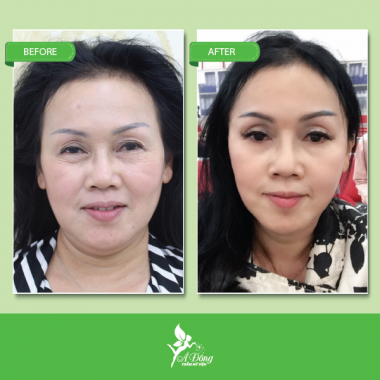 Nâng chân mày bằng chỉ Eye Beauty Cog