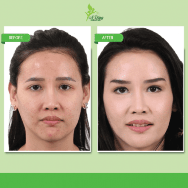 Nâng chân mày bằng chỉ Eye Beauty Cog