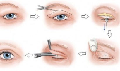 Tiến hành bấm mí lấy mỡ