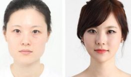 NẠO SILICON VÙNG MẶT