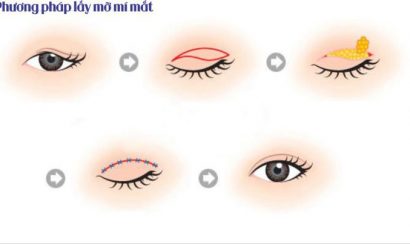 Tiến hành lấy mỡ mí trên