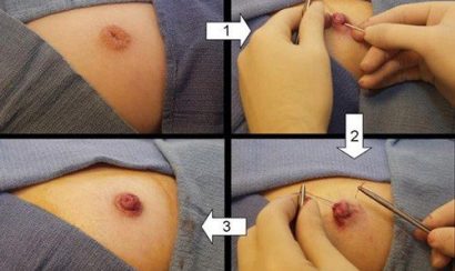 Tiến hành thực hiện kéo núm vú bị tụt 