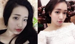 CHỈNH SỬA THẨM MỸ MẮT HỎNG