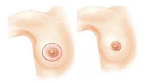 Thực hiện quy trình thu nhỏ quầng vú