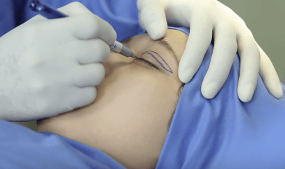 Tiến hành sát trùng gây tê