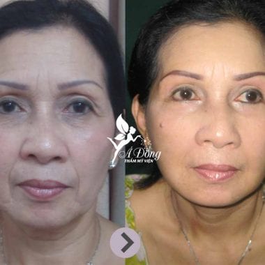 Nâng chân mày phẫu thuật