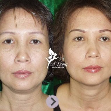 Nâng chân mày phẫu thuật