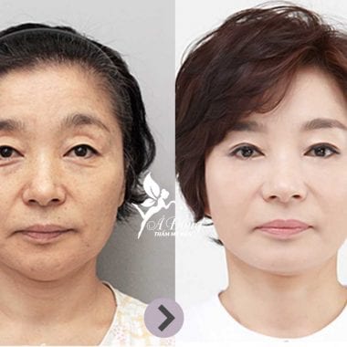 Nâng chân mày phẫu thuật