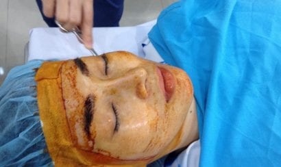 Chuẩn bị trước phẫu thuật